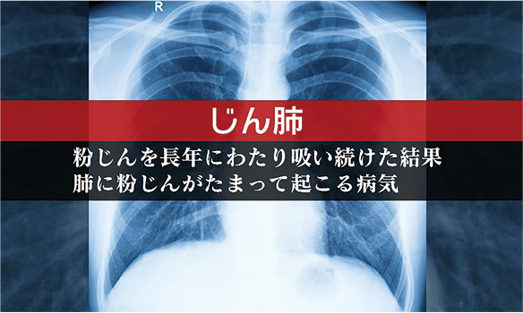 じん肺：
粉じんを長年にわたり吸い続けた結果、肺に粉じんがたまって起こる病気